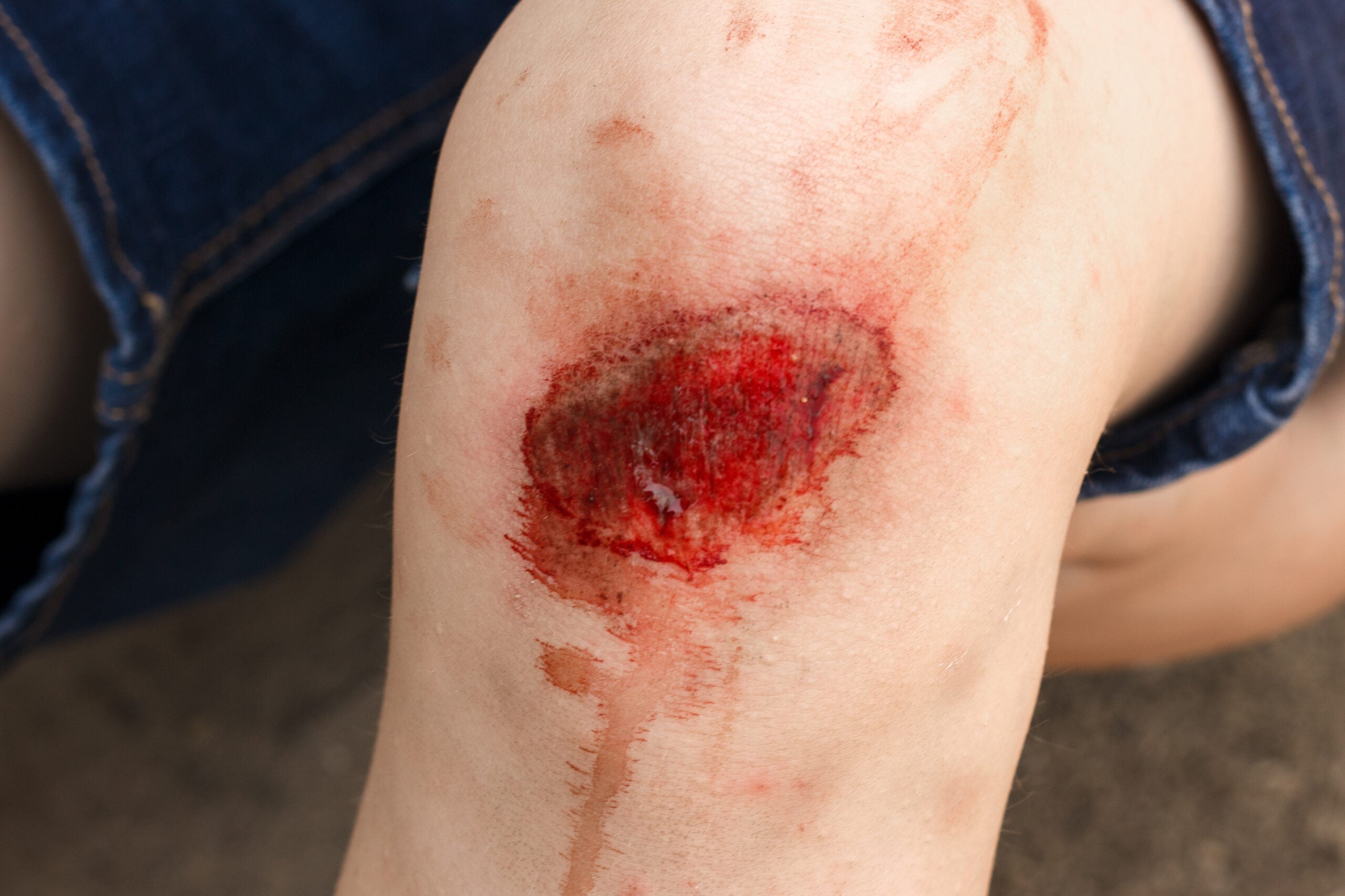 Les infections